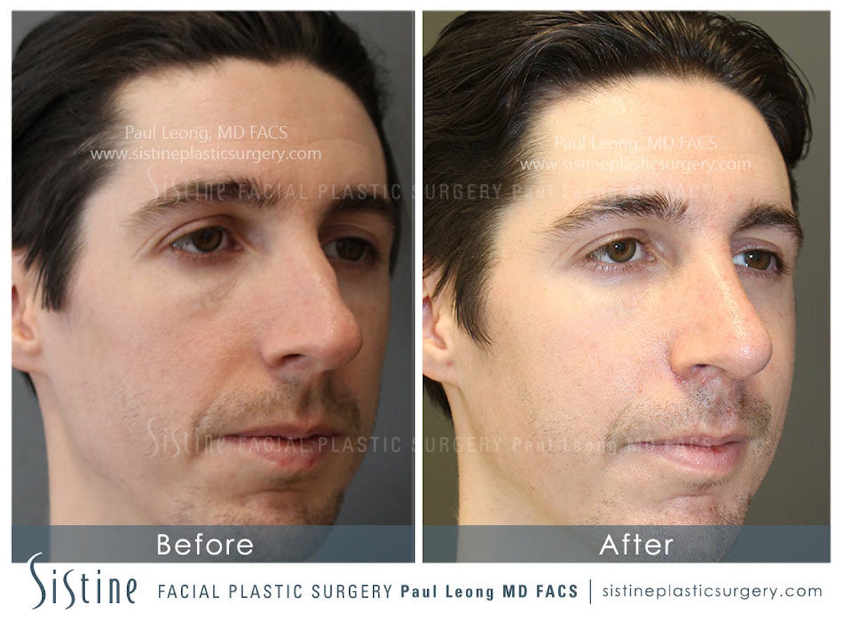 Nose Before & After Gallery - Patient 362593 - Image 2