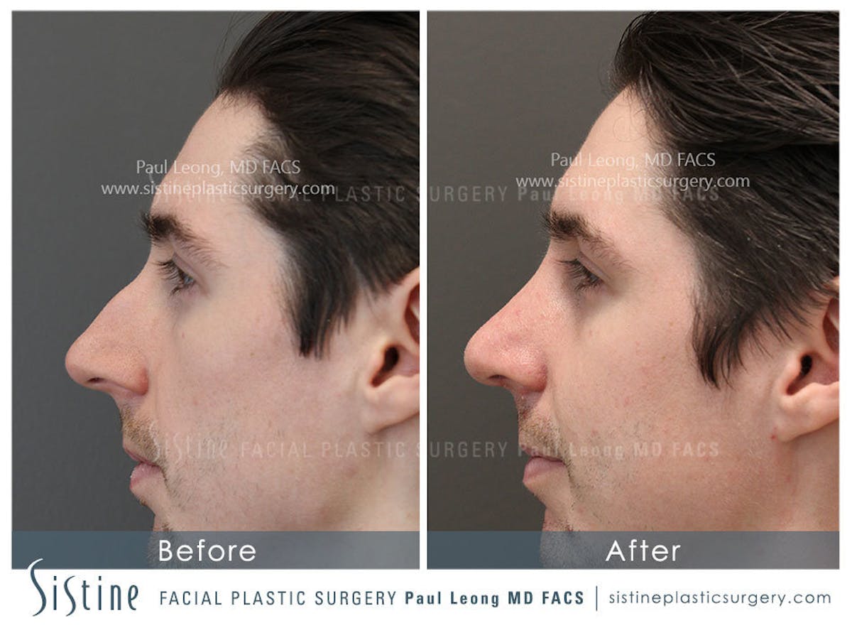 Nose Before & After Gallery - Patient 362593 - Image 3