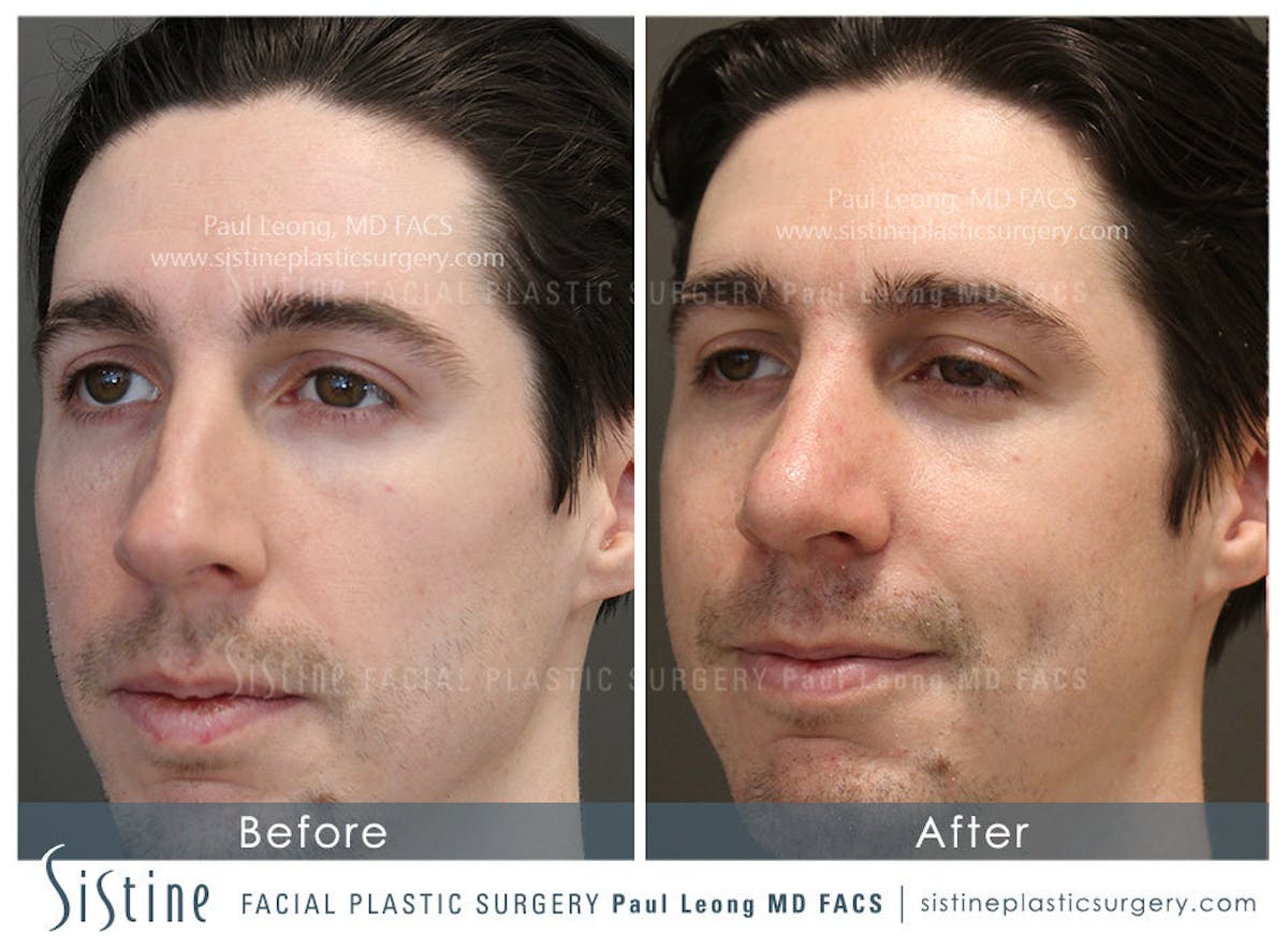 Nose Before & After Gallery - Patient 362593 - Image 4