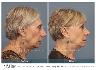 Chin Implant Before & After Gallery - Patient 423928 - Image 1