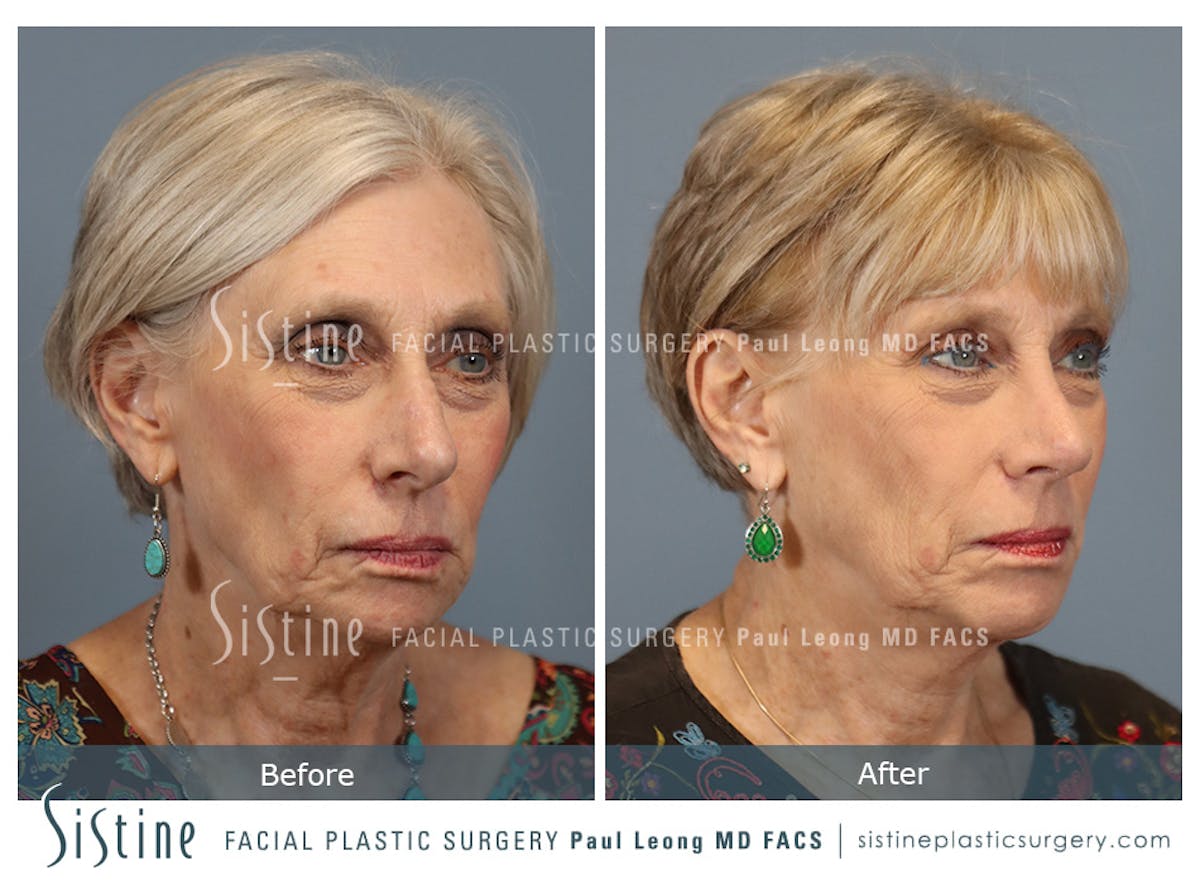 Chin Implant Before & After Gallery - Patient 423928 - Image 2