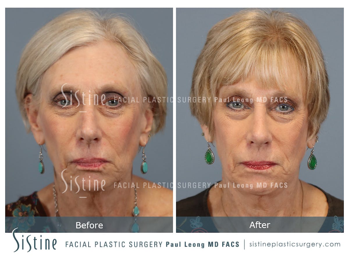 Chin Implant Before & After Gallery - Patient 423928 - Image 3