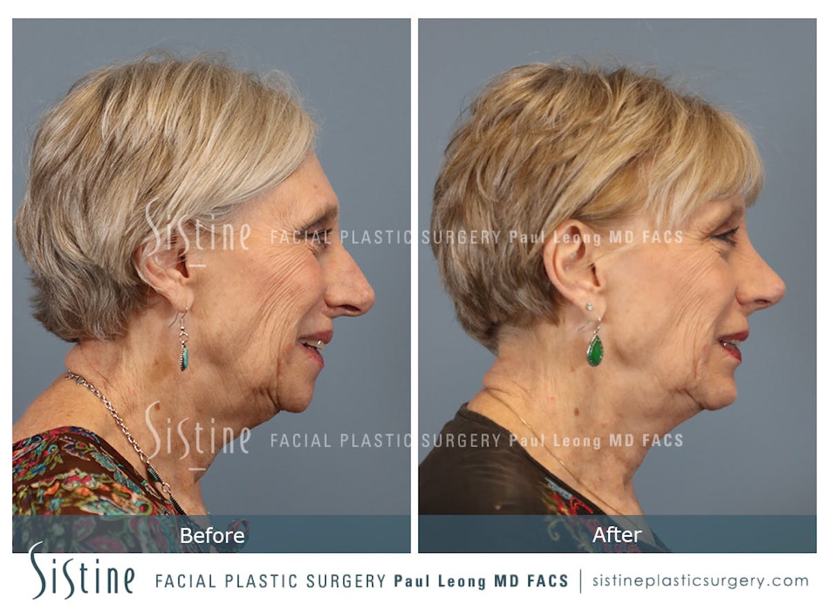 Chin Implant Before & After Gallery - Patient 423928 - Image 4