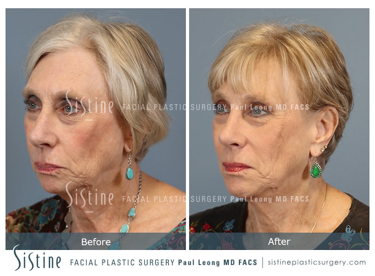 Chin Implant Before & After Gallery - Patient 423928 - Image 5
