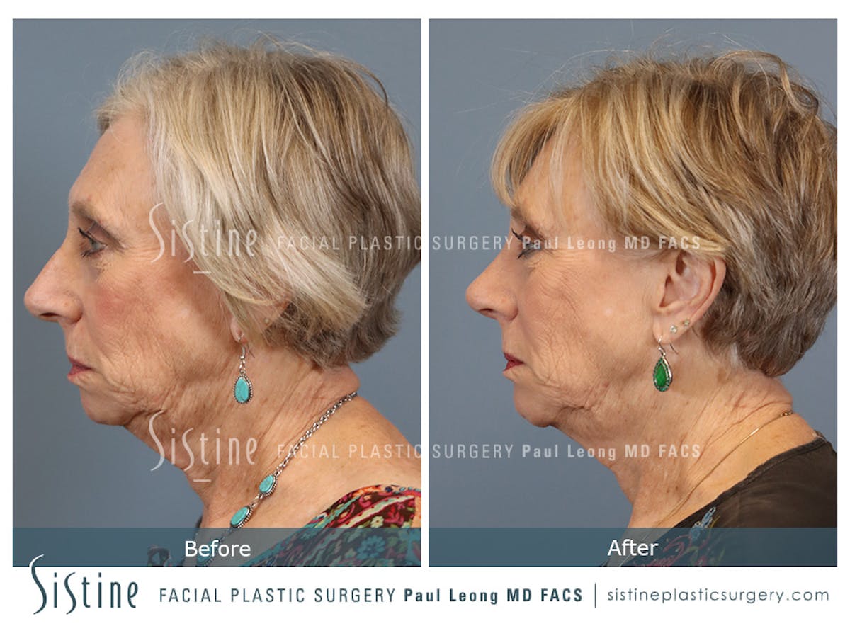 Chin Implant Before & After Gallery - Patient 423928 - Image 6