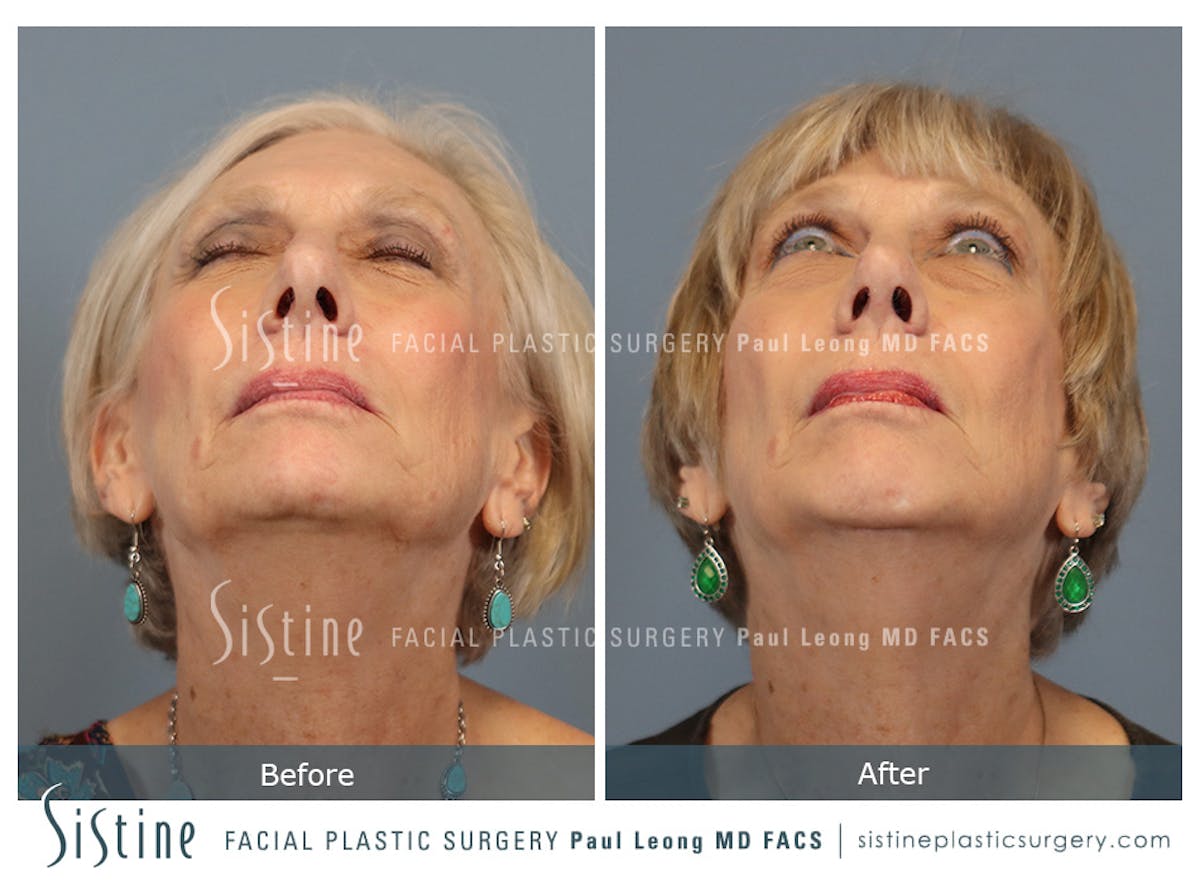 Chin Implant Before & After Gallery - Patient 423928 - Image 7