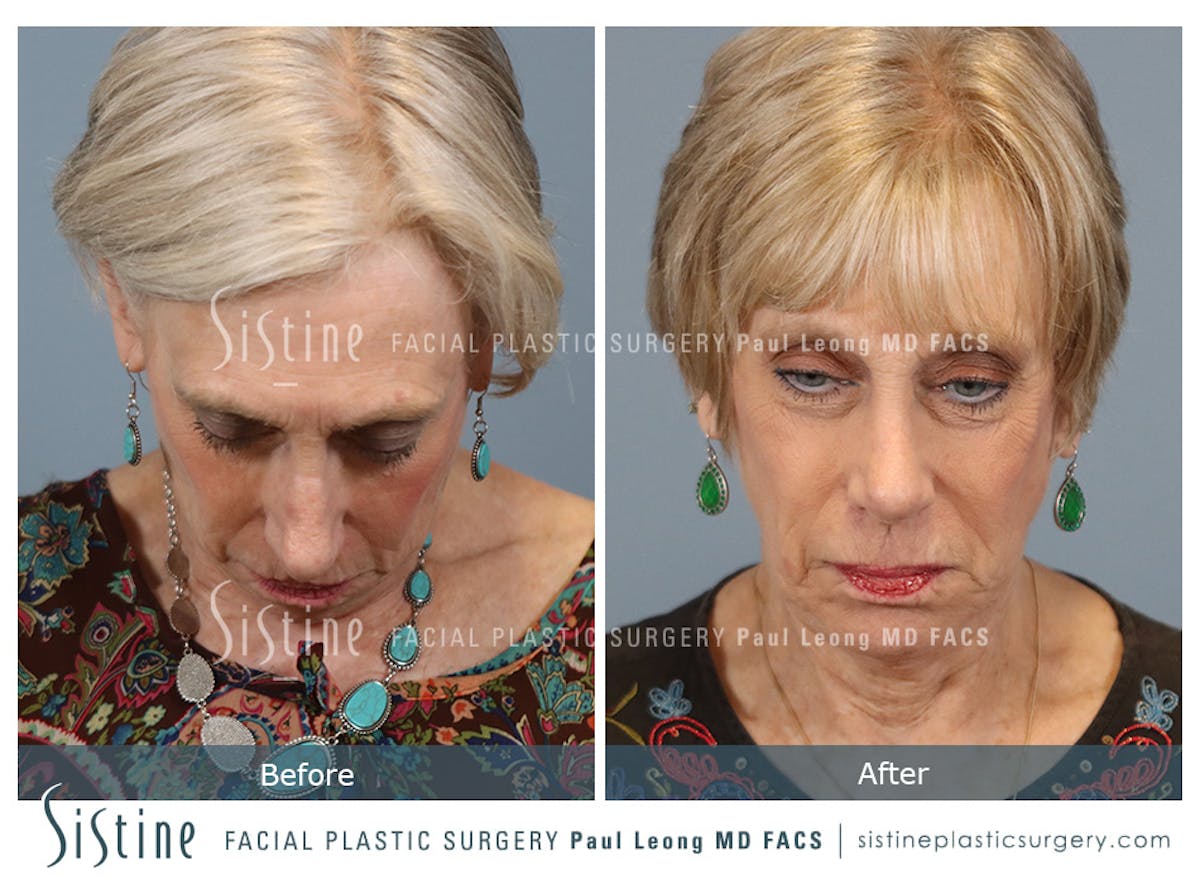 Chin Implant Before & After Gallery - Patient 423928 - Image 8