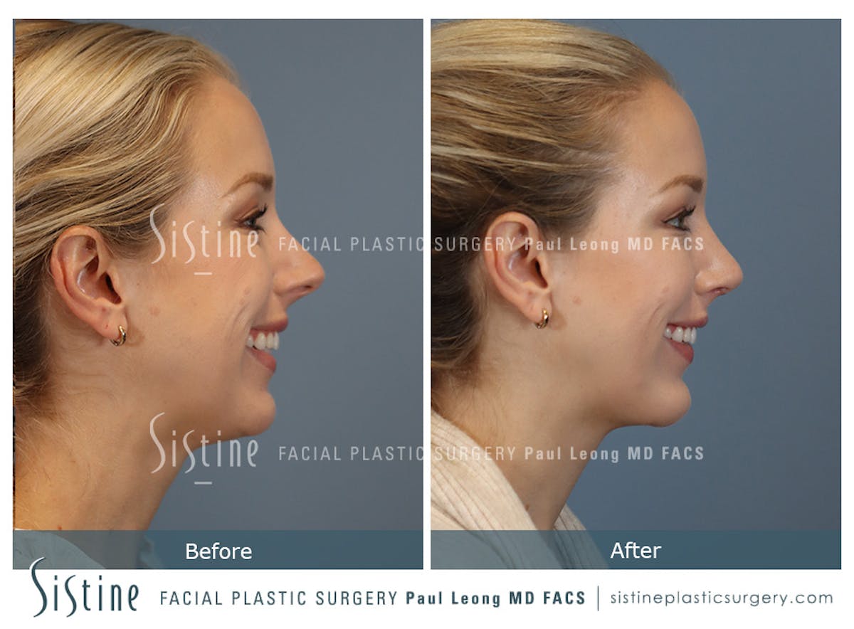 Chin Implant Before & After Gallery - Patient 253722 - Image 1