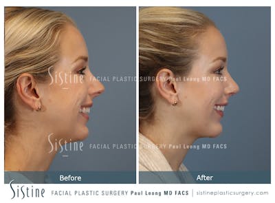 Chin Implant Before & After Gallery - Patient 253722 - Image 1