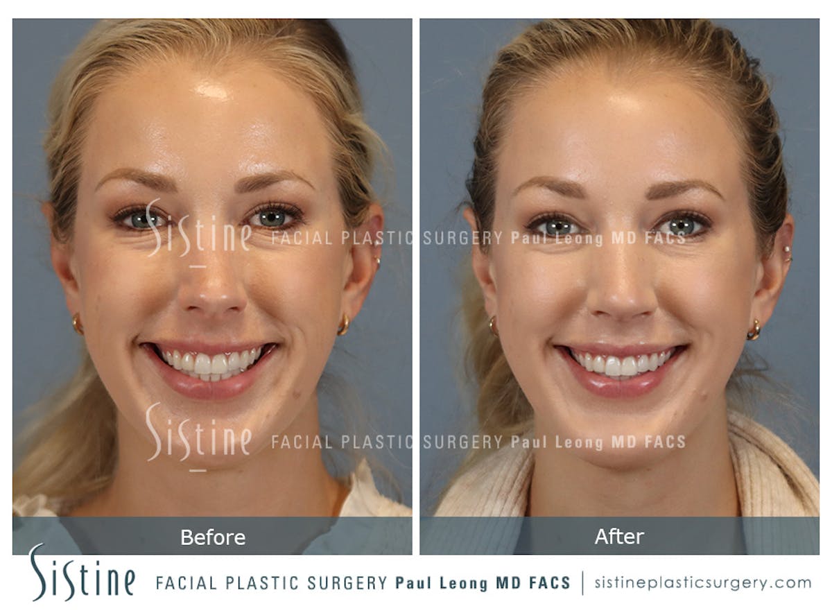Chin Implant Before & After Gallery - Patient 253722 - Image 2