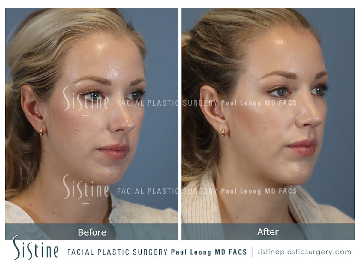 Chin Implant Before & After Gallery - Patient 253722 - Image 3