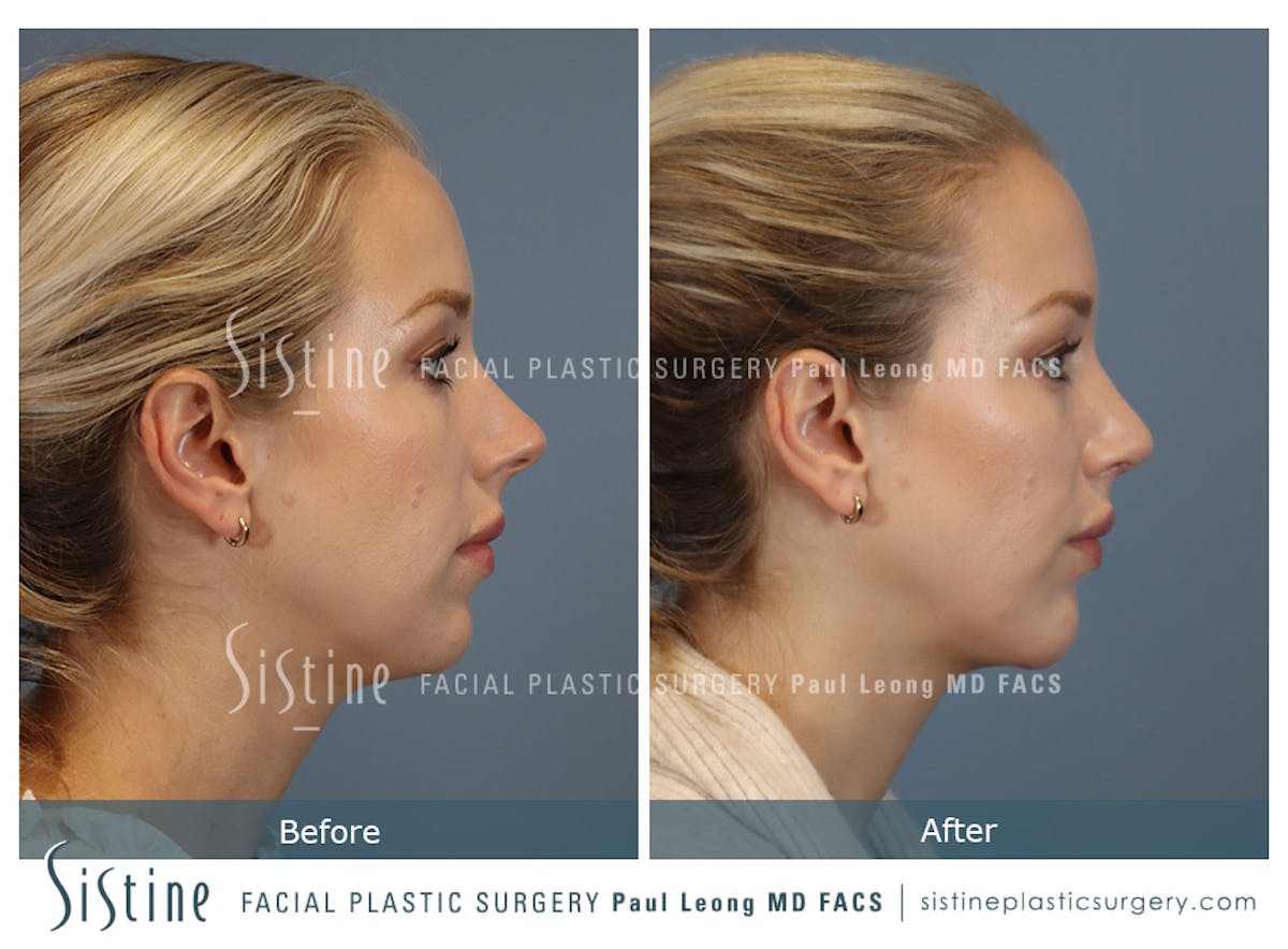 Chin Implant Before & After Gallery - Patient 253722 - Image 4