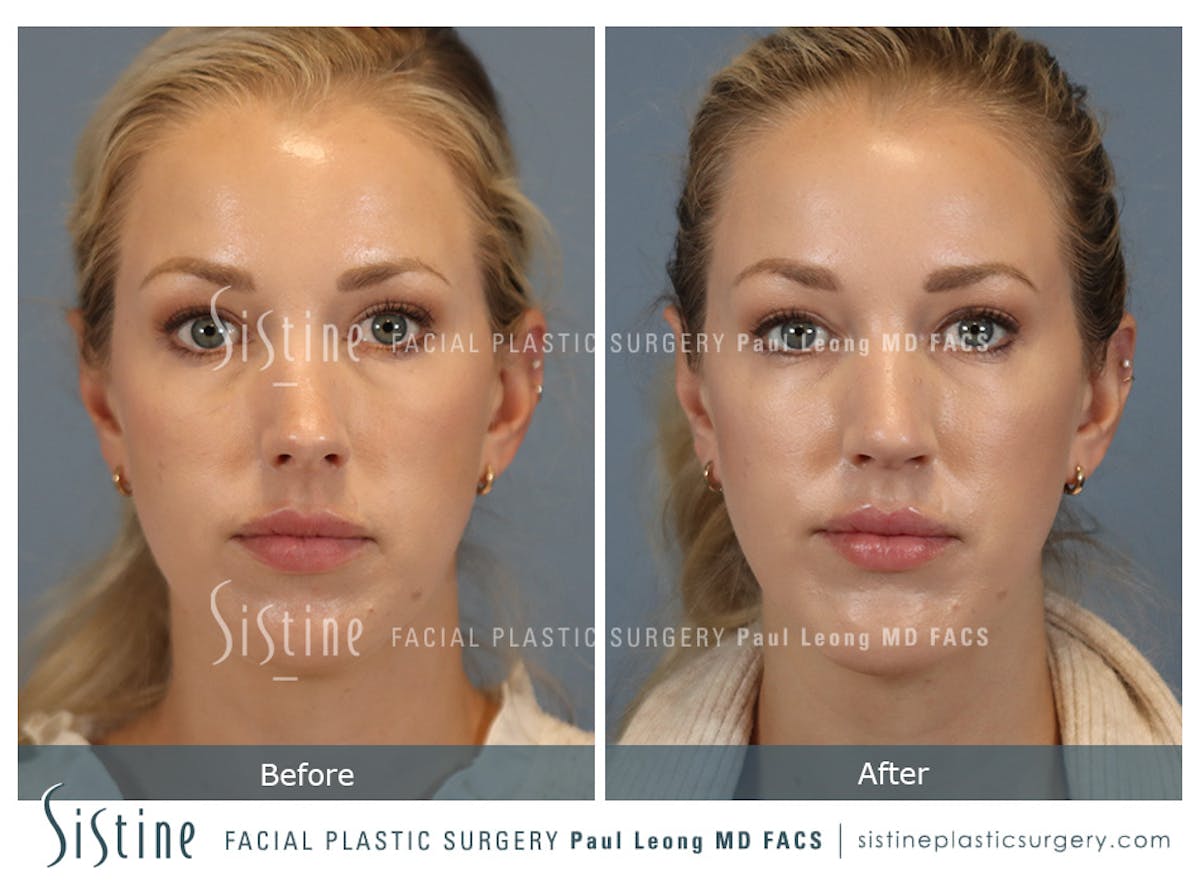Chin Implant Before & After Gallery - Patient 253722 - Image 5