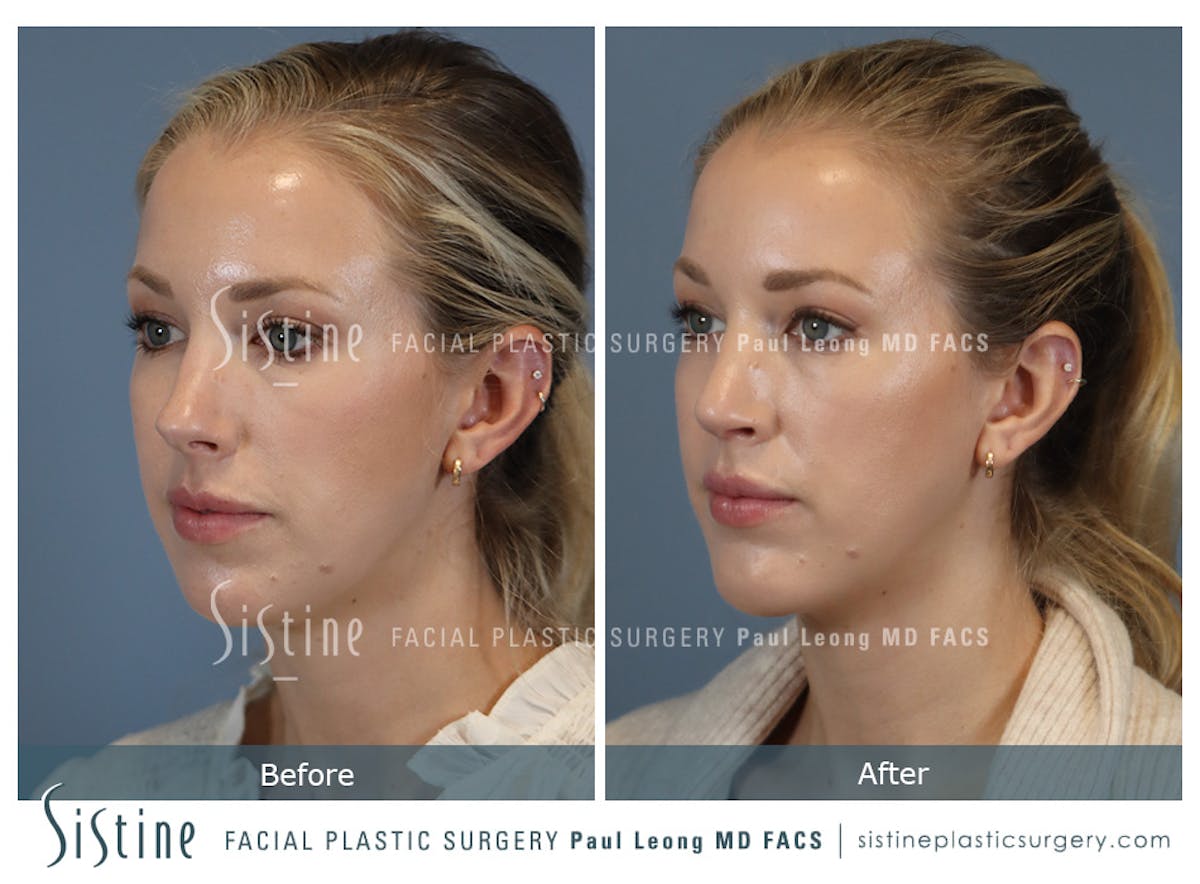 Chin Implant Before & After Gallery - Patient 253722 - Image 6