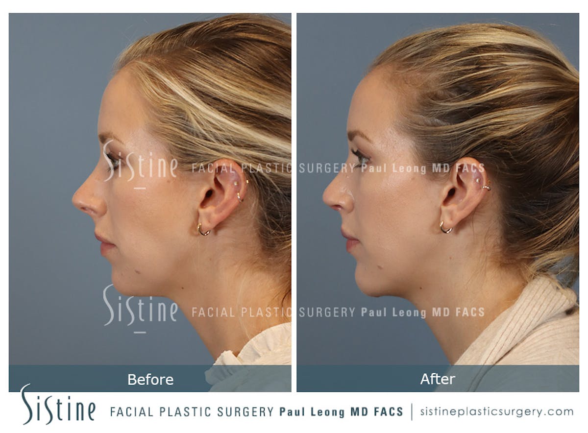 Chin Implant Before & After Gallery - Patient 253722 - Image 7