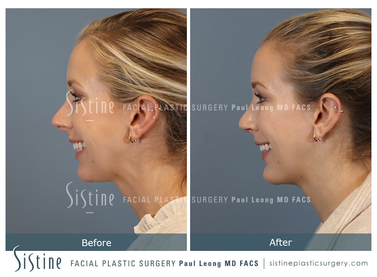 Chin Implant Before & After Gallery - Patient 253722 - Image 8