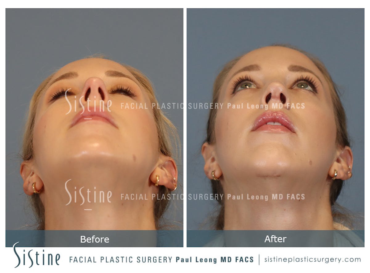 Chin Implant Before & After Gallery - Patient 253722 - Image 9