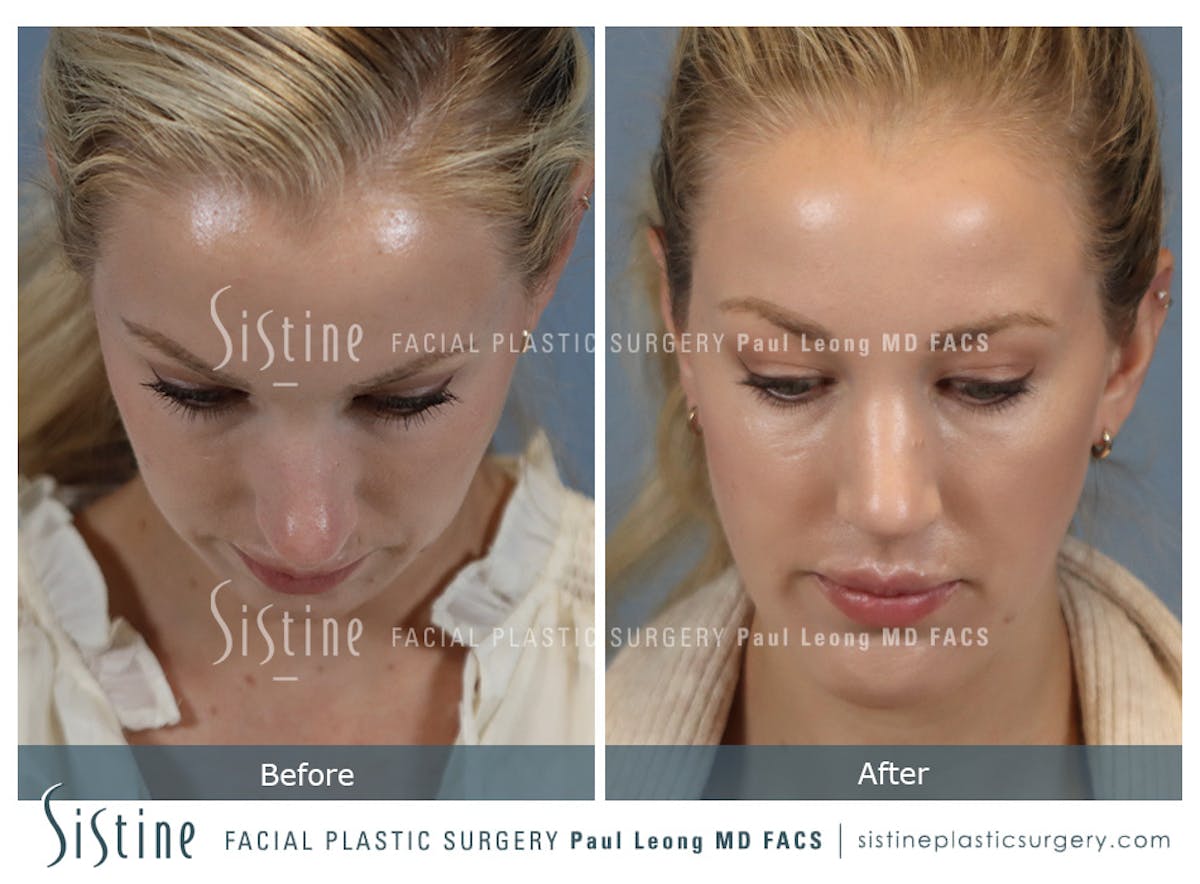 Chin Implant Before & After Gallery - Patient 253722 - Image 10
