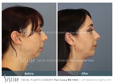 Chin Implant Before & After Gallery - Patient 258389 - Image 1