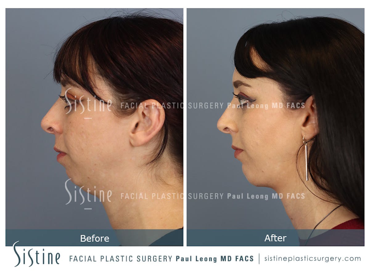 Chin Implant Before & After Gallery - Patient 258389 - Image 2