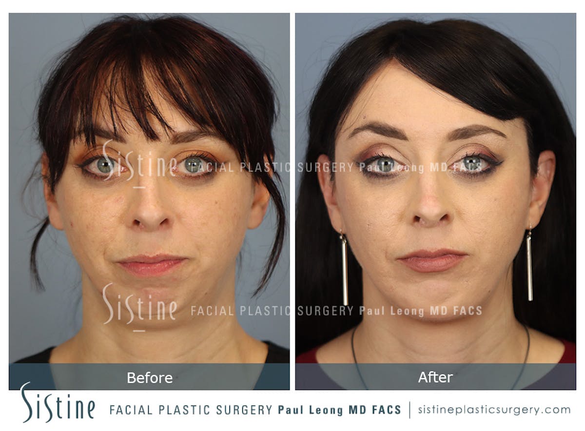 Chin Implant Before & After Gallery - Patient 258389 - Image 3