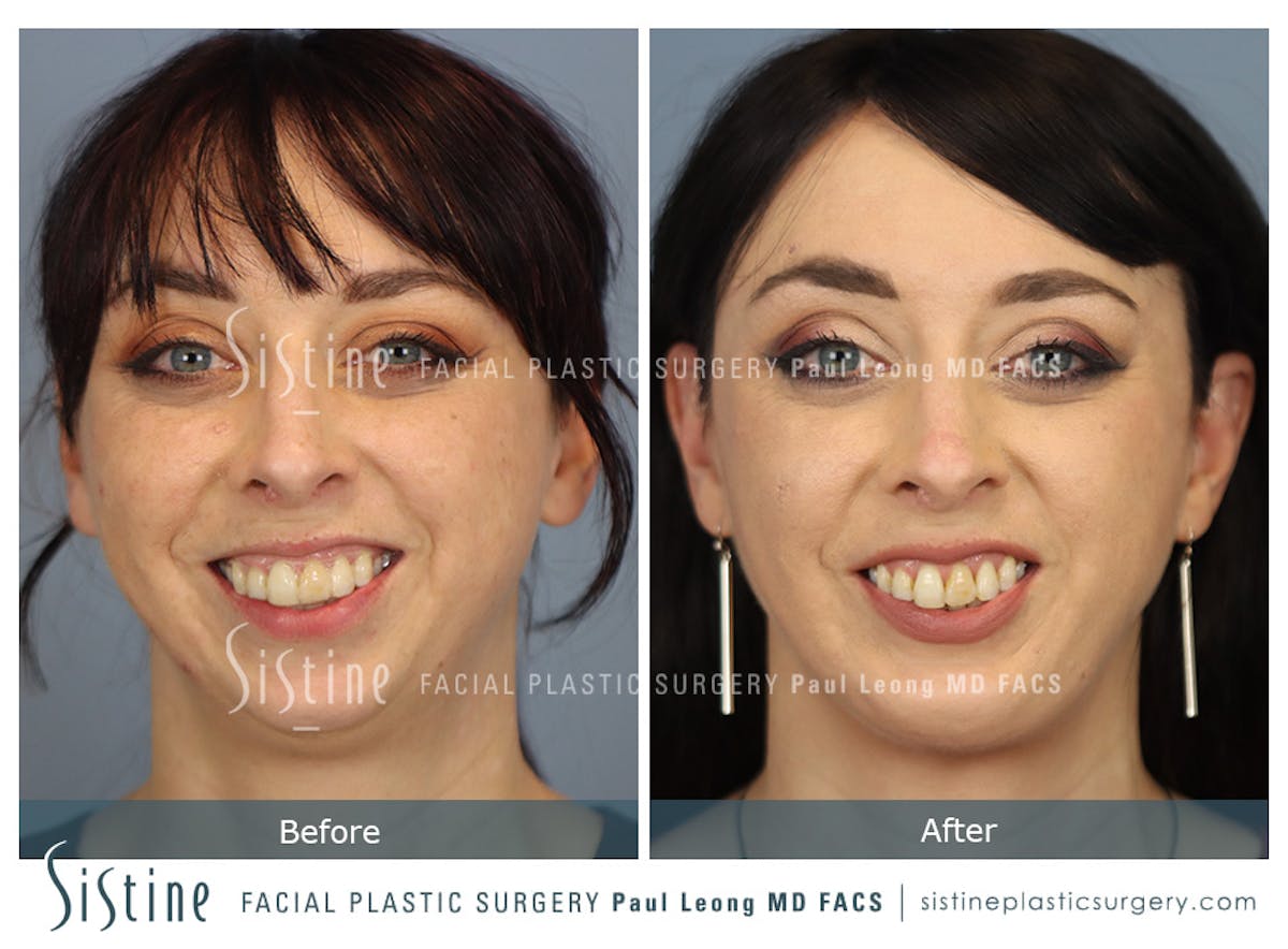 Chin Implant Before & After Gallery - Patient 258389 - Image 4