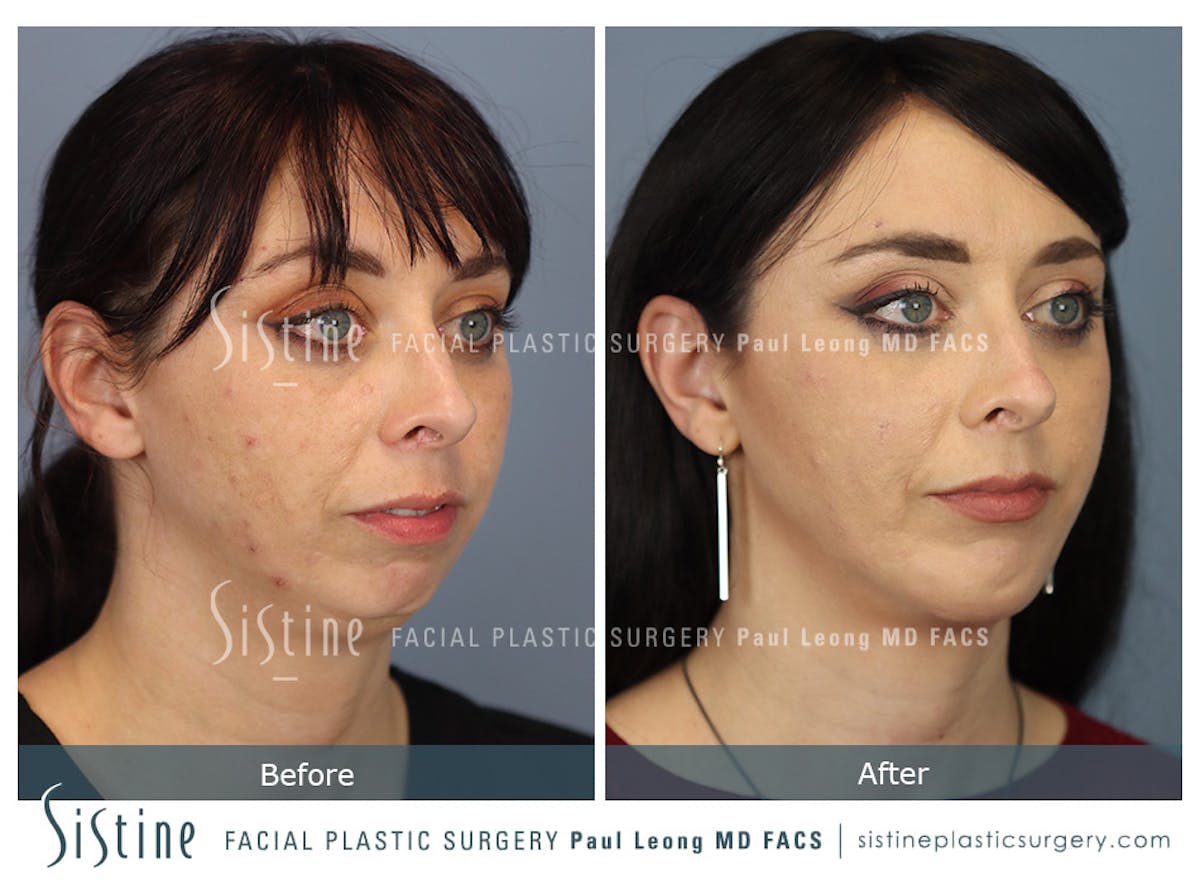 Chin Implant Before & After Gallery - Patient 258389 - Image 5