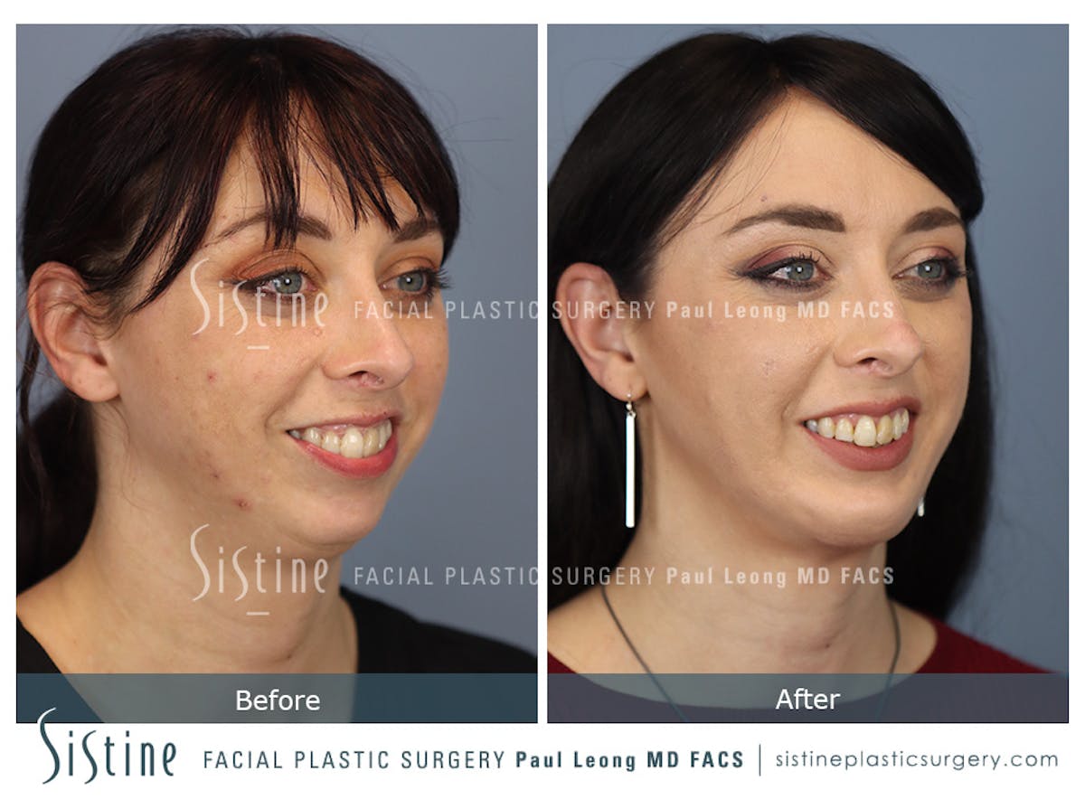 Chin Implant Before & After Gallery - Patient 258389 - Image 6