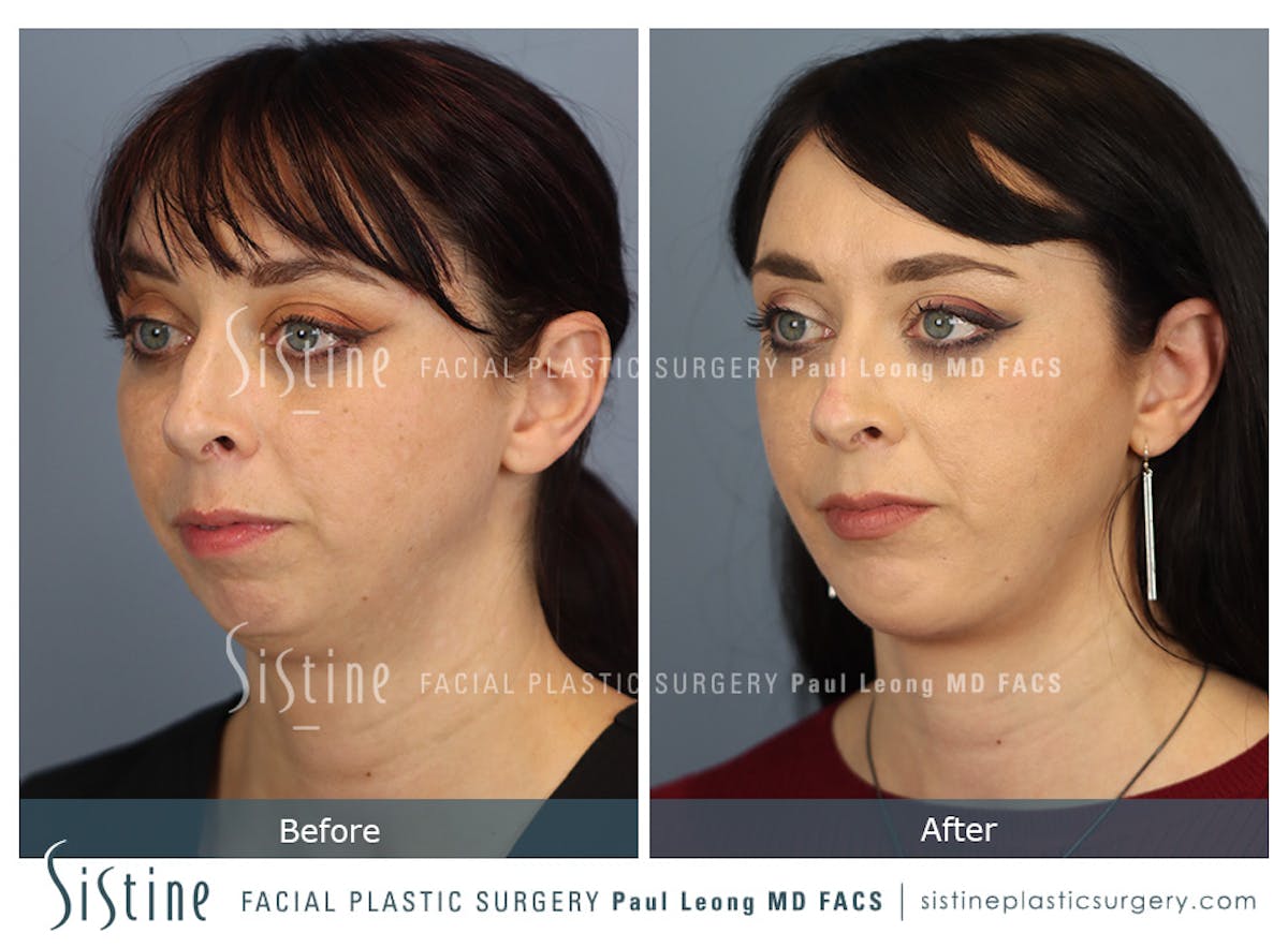 Chin Implant Before & After Gallery - Patient 258389 - Image 7