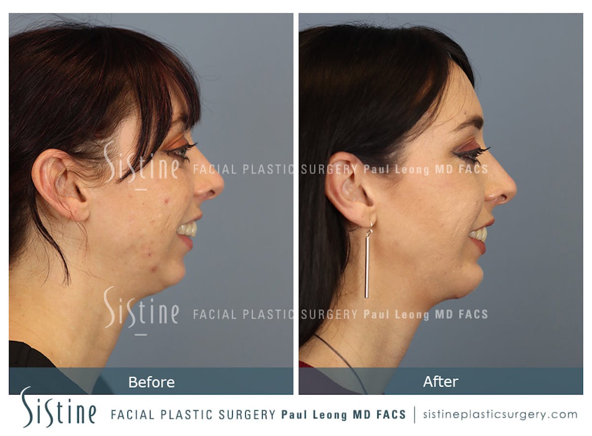 Chin Implant Before & After Gallery - Patient 258389 - Image 8