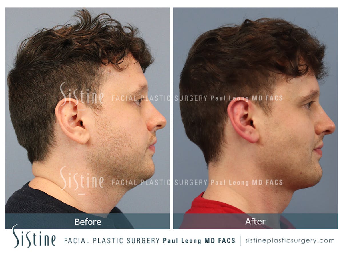Buccal Fat Removal Before & After Gallery - Patient 122320 - Image 3