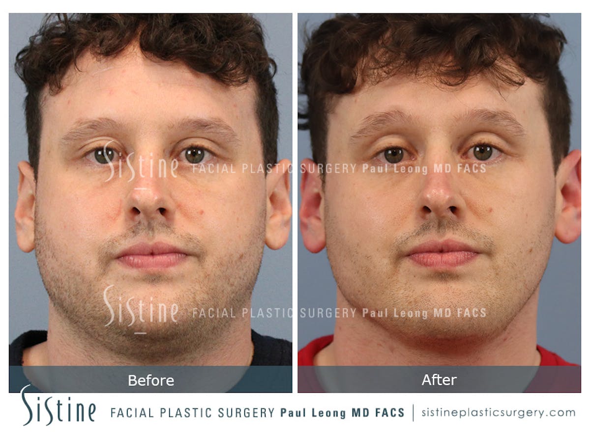 Buccal Fat Removal Before & After Gallery - Patient 122320 - Image 1