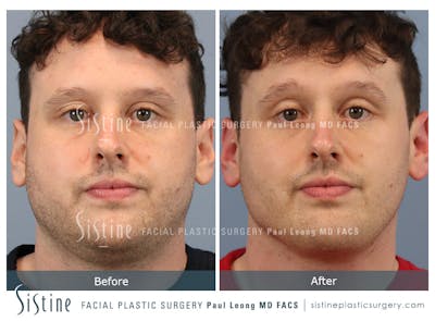 Buccal Fat Removal Before & After Gallery - Patient 122320 - Image 1
