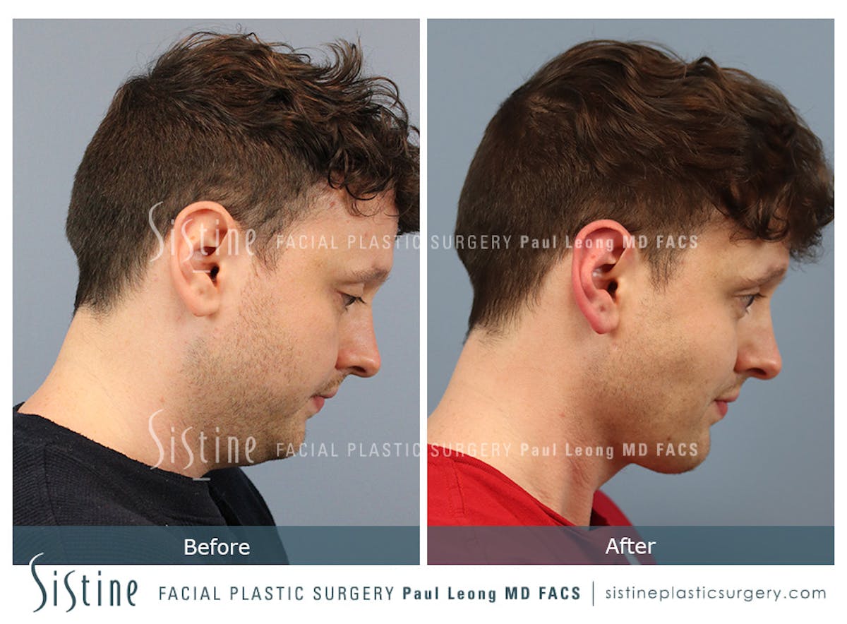 Buccal Fat Removal Before & After Gallery - Patient 122320 - Image 4