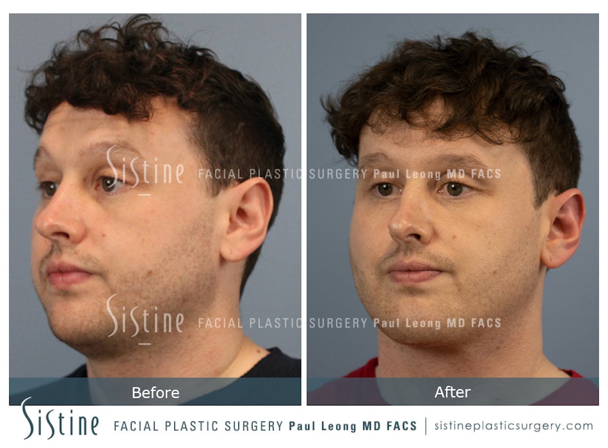 Buccal Fat Removal Before & After Gallery - Patient 122320 - Image 5