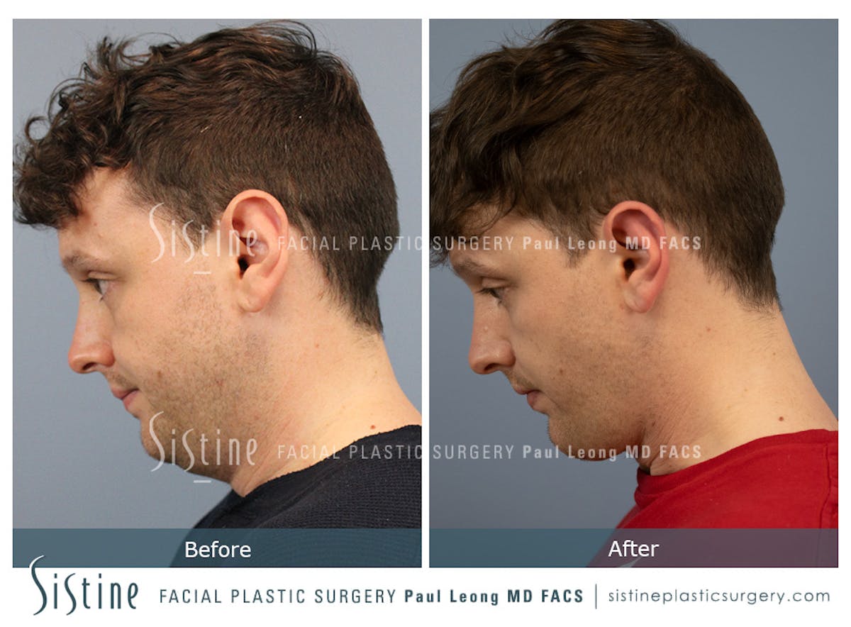 Buccal Fat Removal Before & After Gallery - Patient 122320 - Image 6