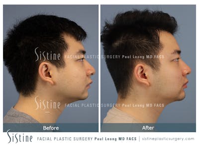 Chin Implant Before & After Gallery - Patient 410205 - Image 1