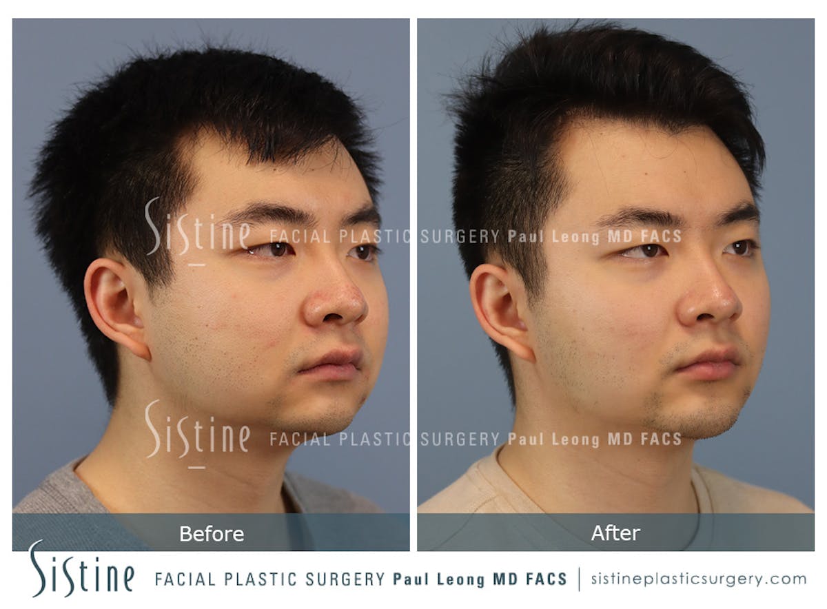 Buccal Fat Removal Before & After Gallery - Patient 253657 - Image 2