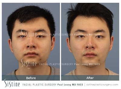 Buccal Fat Removal Before & After Gallery - Patient 253657 - Image 1