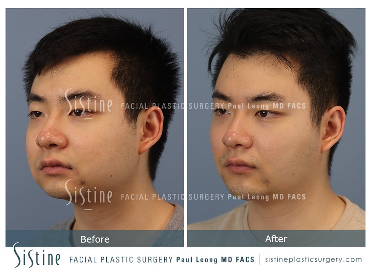 Buccal Fat Removal Before & After Gallery - Patient 253657 - Image 4