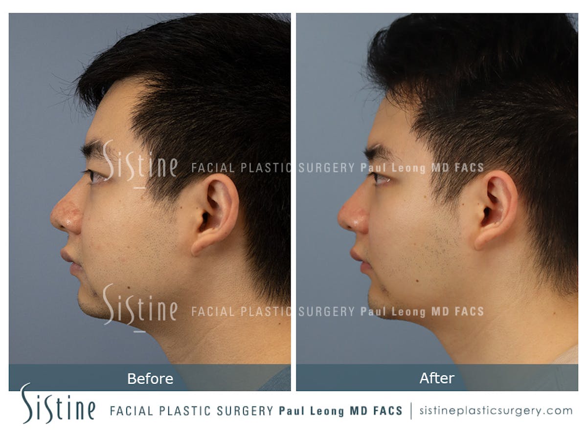 Buccal Fat Removal Before & After Gallery - Patient 253657 - Image 5