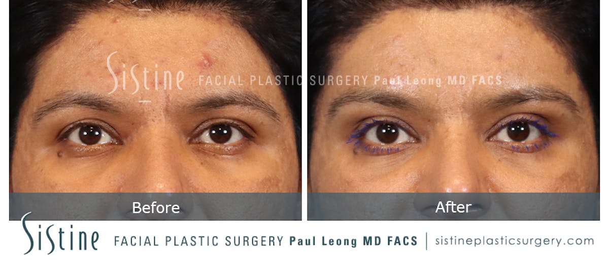Browlift Before & After Gallery - Patient 201786 - Image 1