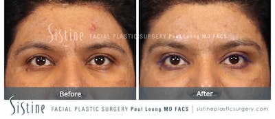 Browlift Before & After Gallery - Patient 201786 - Image 1