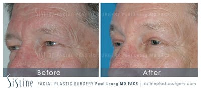 Browlift Before & After Gallery - Patient 299987 - Image 1