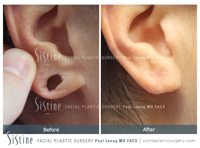Earlobe Repair Before & After Gallery - Patient 477815 - Image 1
