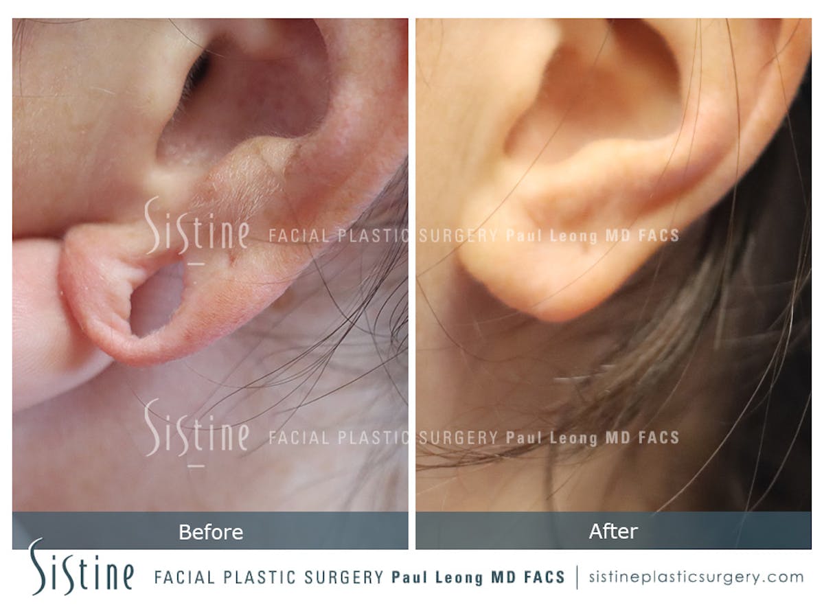 Earlobe Repair Before & After Gallery - Patient 477815 - Image 2