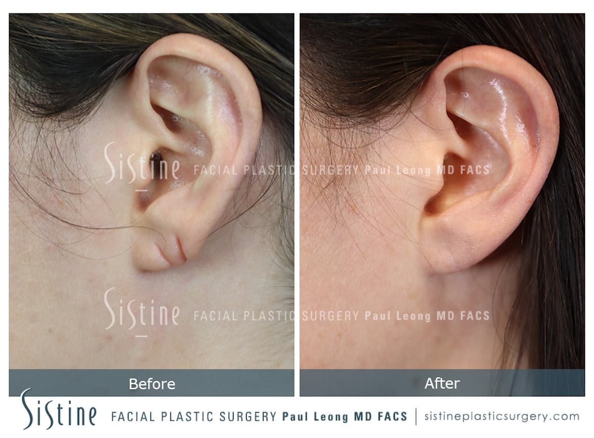 Earlobe Repair Before & After Gallery - Patient 340867 - Image 1