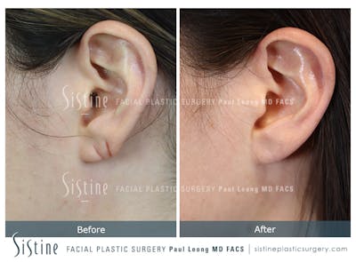 Earlobe Repair Before & After Gallery - Patient 340867 - Image 1