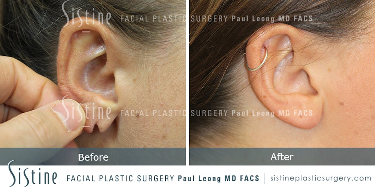 Earlobe Repair Before & After Gallery - Patient 317958 - Image 1