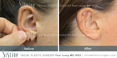 Earlobe Repair Before & After Gallery - Patient 317958 - Image 1